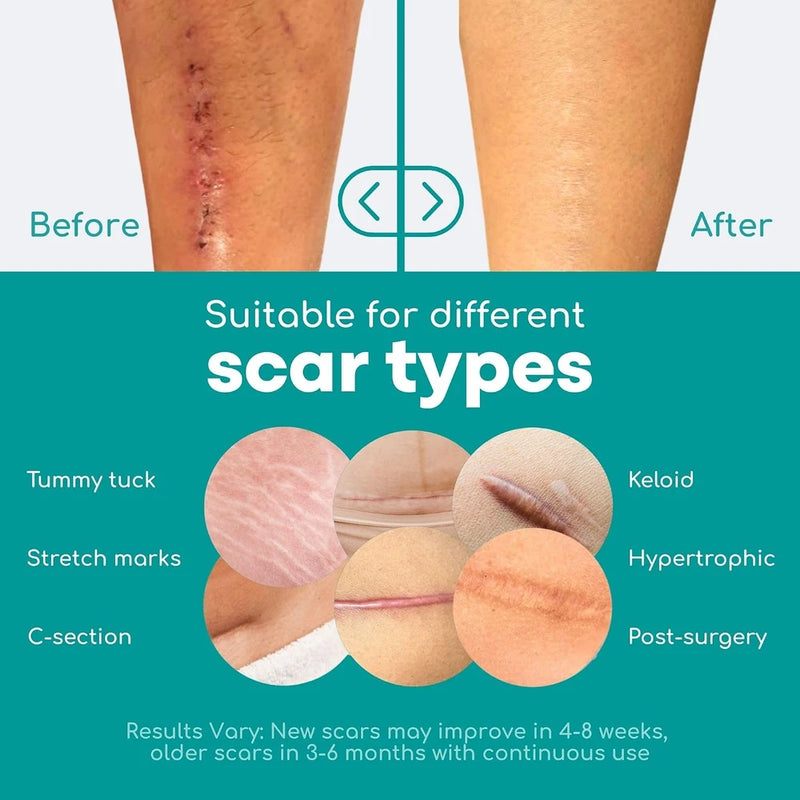 Medical Grade Silicone Scar Tape for Acne Management
